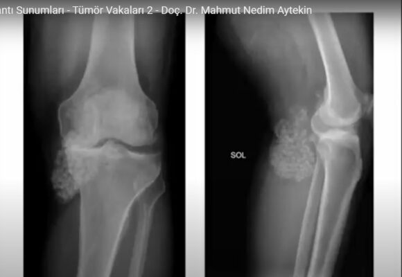 Bilimsel Toplantı Sunumları – Tümör Vakaları 2