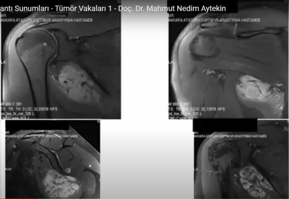 Bilimsel Toplantı Sunumları – Tümör Vakaları 1