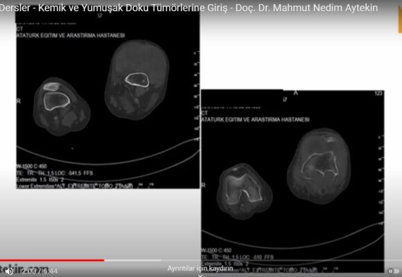 Akademik Dersler – Kemik ve Yumuşak Doku Tümörlerine Giriş